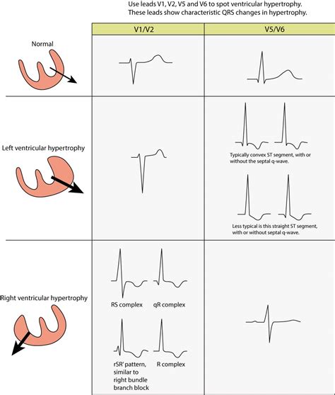 signs of lvh on ecg